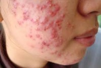 BẠN BIẾT GÌ VỀ MỤN TRỨNG CÁ