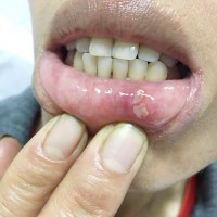 BỆNH LOÉT ÁP TƠ