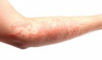 CUỐI CÙNG ĐÃ CÓ THUỐC TRỊ BỆNH ECZEMA